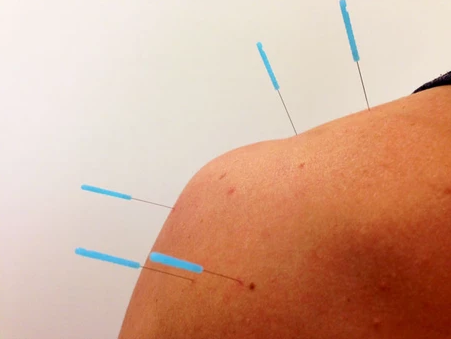 What Is Dry Needling and Should I Try It?